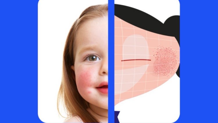 Herramienta modifica dibujos animados para representar a niños con problemas dermatológicos 1 Herramienta modifica dibujos animados para representar a niños con problemas dermatológicos