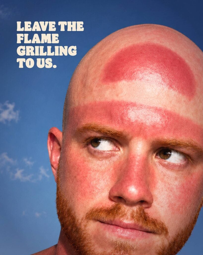 Burger King convierte las quemaduras solares en una campaña para hablar de sus hamburguesas 3 geh7j5xwzrwm339xp3h4og2otwd8